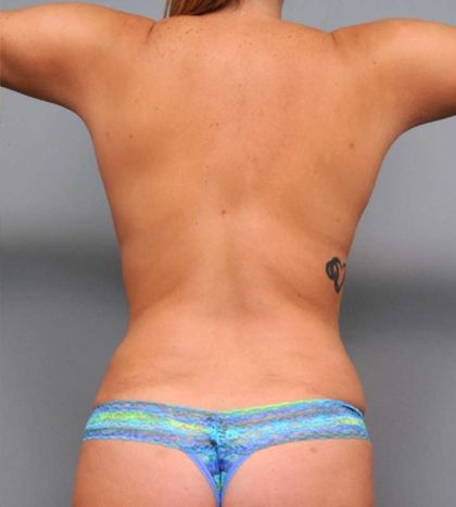 Liposuction Before & After Patient #662