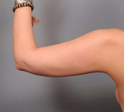 Liposuction Before & After Patient #669
