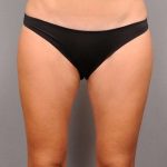 Liposuction Before & After Patient #674