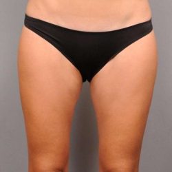 Liposuction Before & After Patient #674