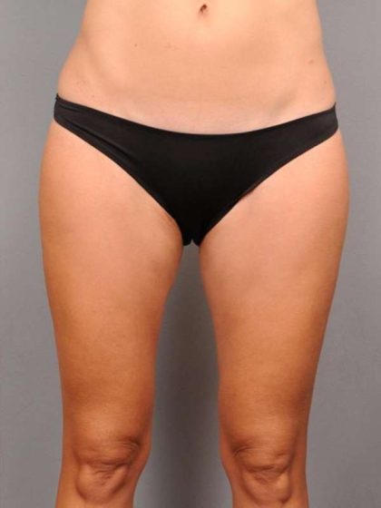 Liposuction Before & After Patient #674