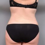 Liposuction Before & After Patient #681