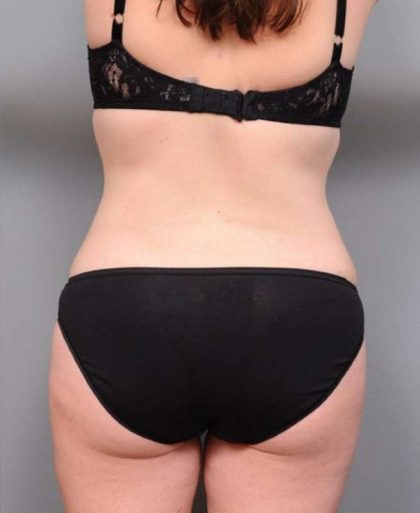 Liposuction Before & After Patient #681