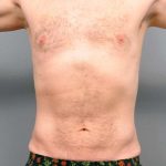 Liposuction Before & After Patient #688
