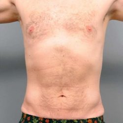 Liposuction Before & After Patient #688