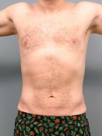 Liposuction Before & After Patient #688