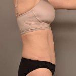 Tummy Tuck Before & After Patient #263
