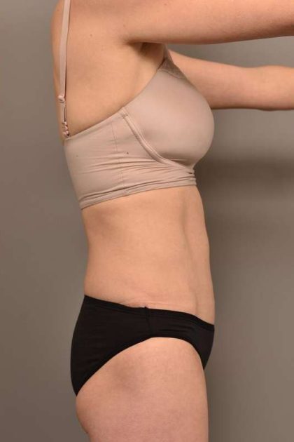 Tummy Tuck Before & After Patient #263