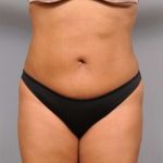 Liposuction Before & After Patient #695