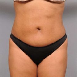 Liposuction Before & After Patient #695
