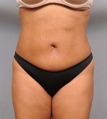 Liposuction Before & After Patient #695