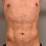 Liposuction Before & After Patient #704