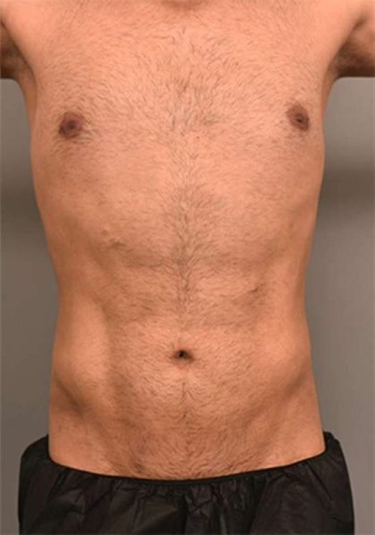Liposuction Before & After Patient #704