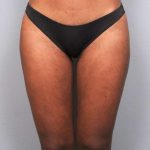 Liposuction Before & After Patient #709