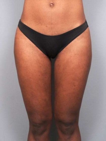 Liposuction Before & After Patient #709
