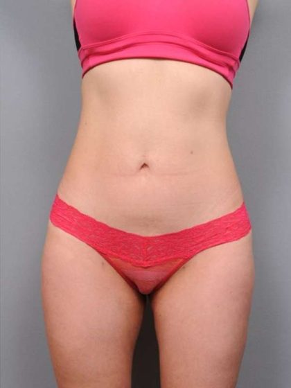 Liposuction Before & After Patient #716