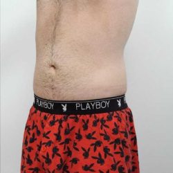 Liposuction Before & After Patient #721