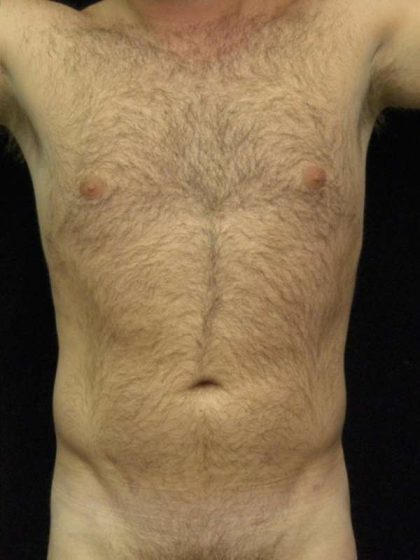 Liposuction Before & After Patient #726