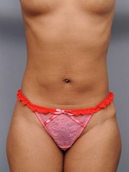 Liposuction Before & After Patient #738