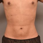 Liposuction Before & After Patient #749