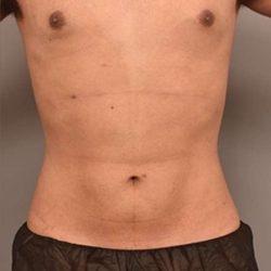 Liposuction Before & After Patient #749