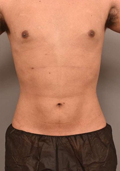 Liposuction Before & After Patient #749