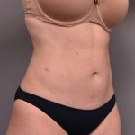 Liposuction Before & After Patient #756