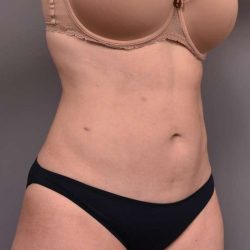 Liposuction Before & After Patient #756