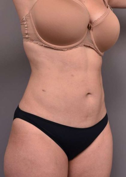 Liposuction Before & After Patient #756