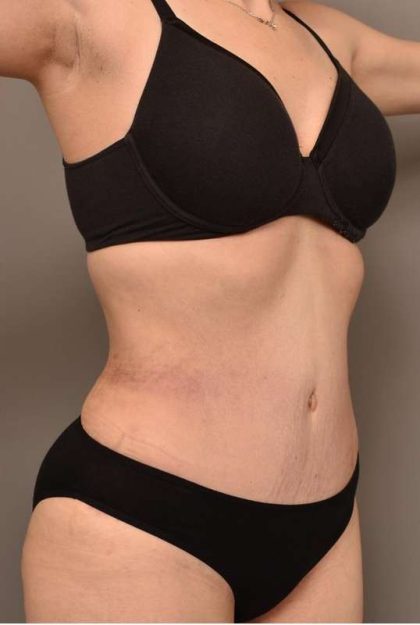 Tummy Tuck Before & After Patient #266