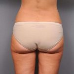 Liposuction Before & After Patient #761