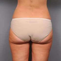 Liposuction Before & After Patient #761