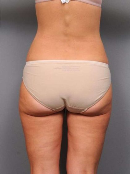 Liposuction Before & After Patient #761
