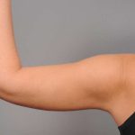 Liposuction Before & After Patient #768