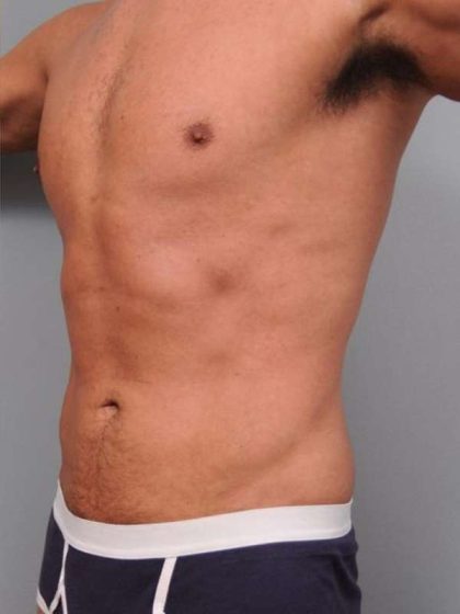 Liposuction Before & After Patient #783