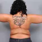 Arm Lift Before & After Patient #790