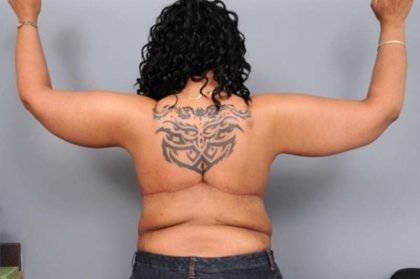 Arm Lift Before & After Patient #790