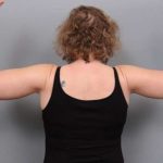 Arm Lift Before & After Patient #795