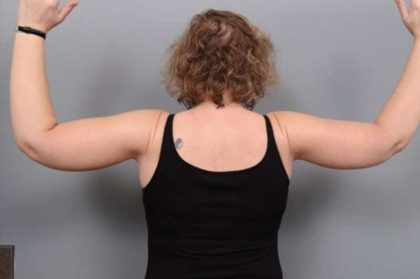 Arm Lift Before & After Patient #795