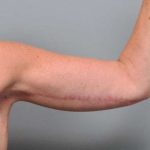 Arm Lift Before & After Patient #800