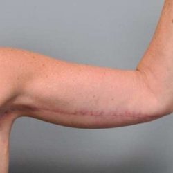 Arm Lift Before & After Patient #800