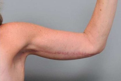 Arm Lift Before & After Patient #800