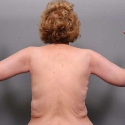 Arm Lift Before & After Patient #807