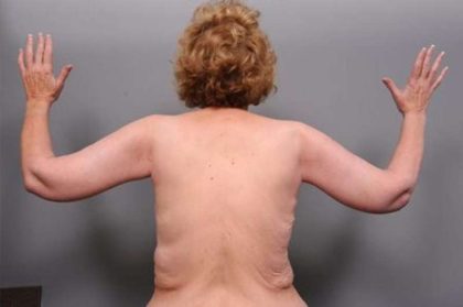 Arm Lift Before & After Patient #807