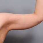 Arm Lift Before & After Patient #814