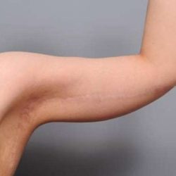 Arm Lift Before & After Patient #814