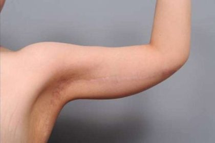 Arm Lift Before & After Patient #814
