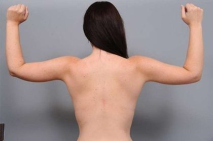 Arm Lift Before & After Patient #819