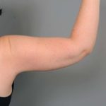 Arm Liposuction Before & After Patient #826