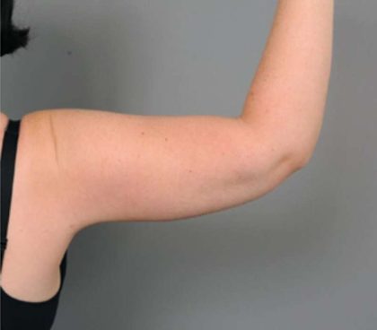 Arm Liposuction Before & After Patient #826